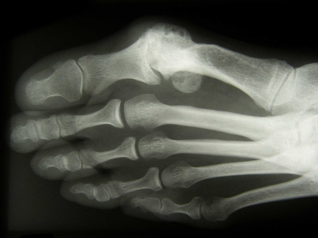 Hallux rigidus (Großzehengrundgelenksarthrose) - Röntgenaufnahme eines Fußes mit Grosszehengrundgelenksarthrose, der medizinisch behandelt wird.