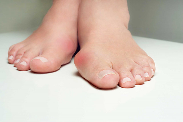 Hallux valgus (Großzehenballen) - Nahaufnahme von Füßen mit weißem Nagellack, mit einer Auffälligkeit am Zeh.