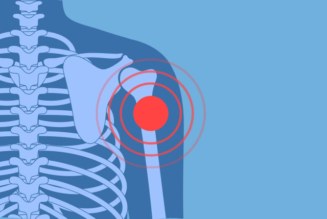 Schulter - Vereinfachte anatomische grafische Darstellung der Schulter mit roter Signal-Markierung