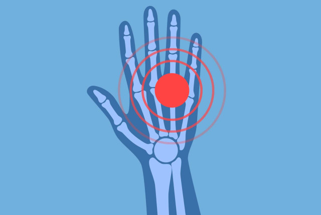 Hand - Vereinfachte anatomische grafische Darstellung der Hand mit roter Signal-Markierung