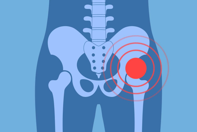 Hüfte - Vereinfachte anatomische grafische Darstellung der Hüfte mit roter Signal-Markierung
